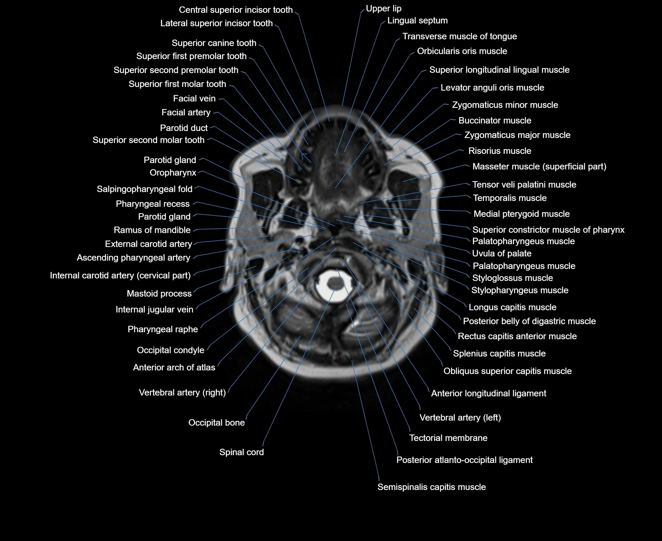MRI Neck 3D labelled cross section anatomy axial 3t image-00001-00023.webp